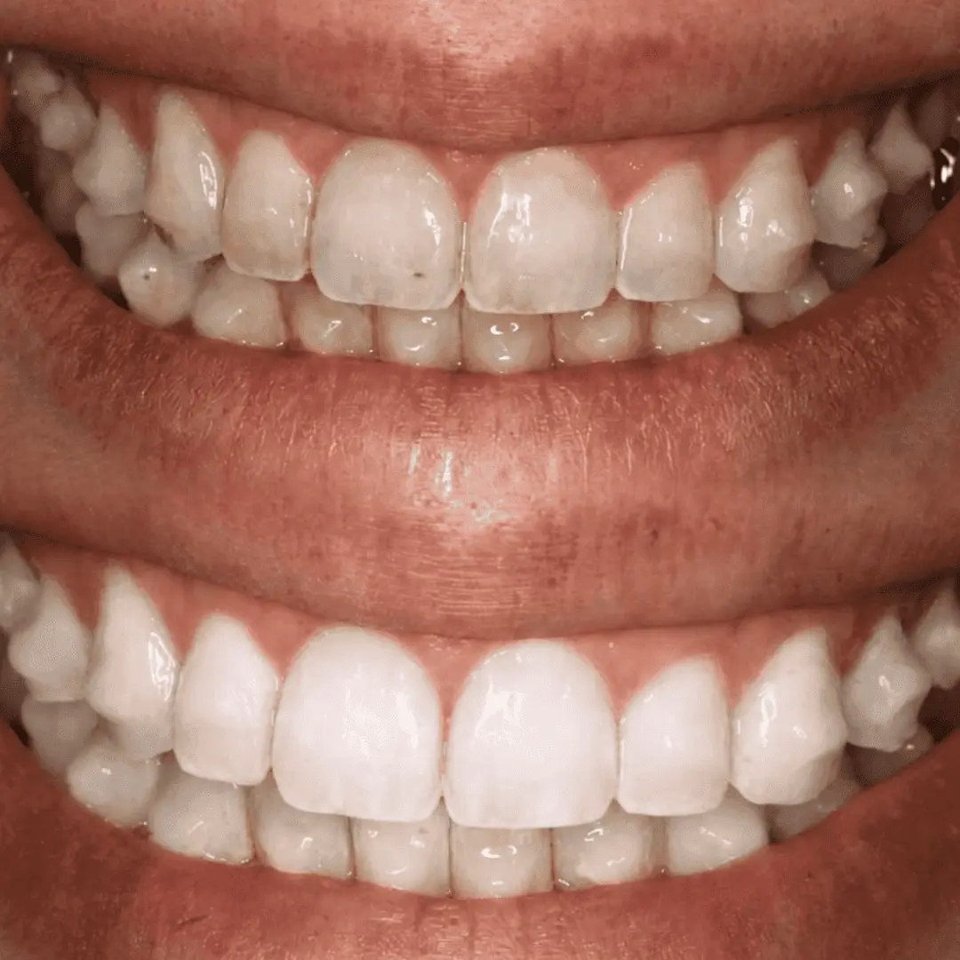 Clareamento Dental